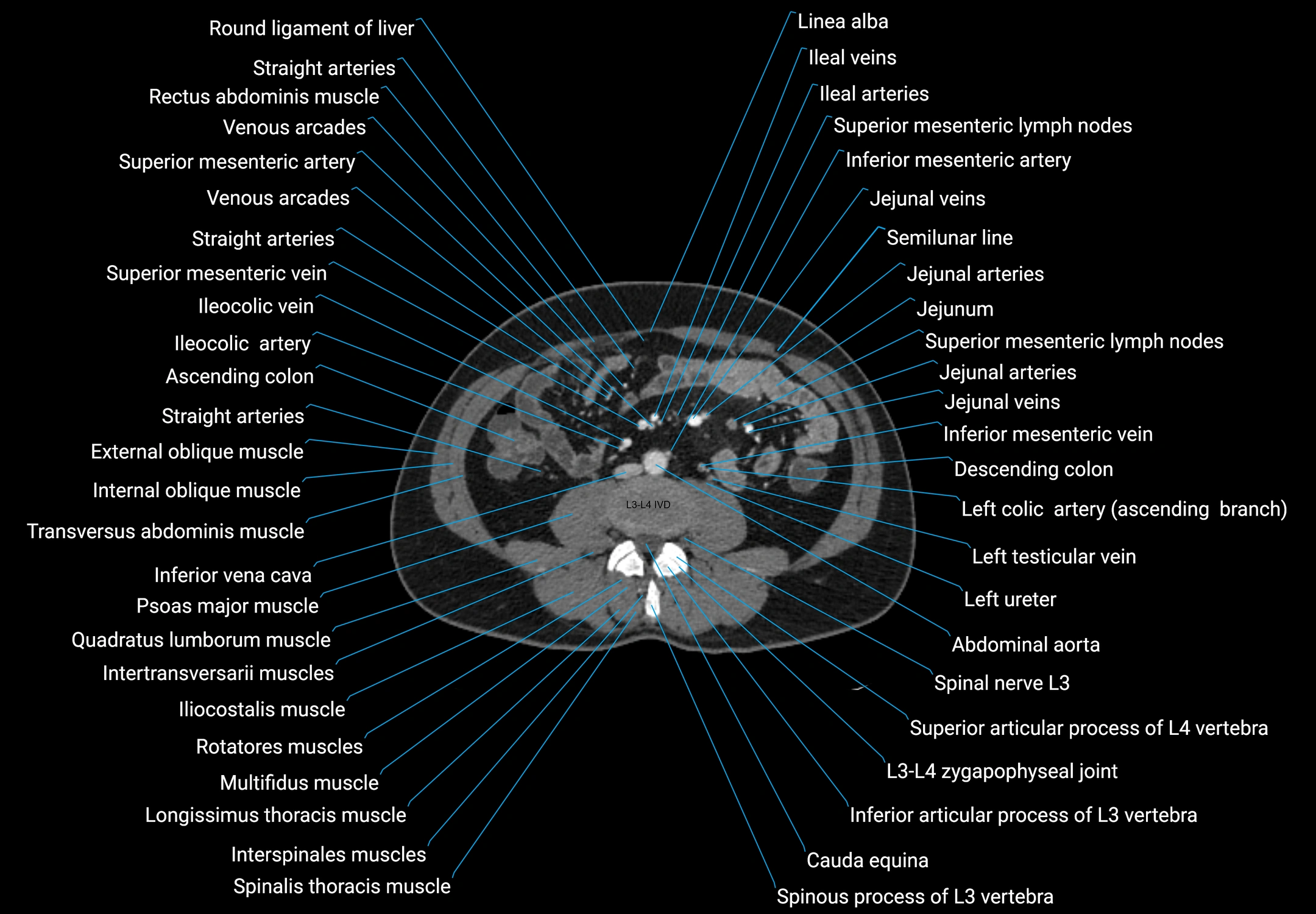 CT male pelvis axial cross sectional anatomy labelled radiology image -00100.webp
